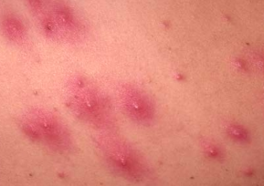 Rash 101: The Most Common Types of Skin Rashes