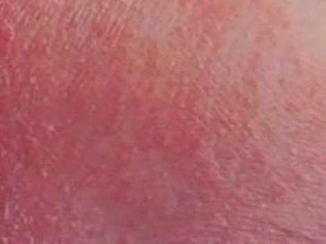 Skin Rash: 59 Pictures, Causes, Treatments - Healthline