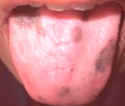 How to Get Rid of Geographic Tongue (with Pictures) | eHow