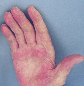 What is Palmar Erythema? (with pictures) - wiseGEEK