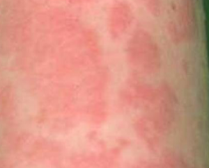 Pictures Of Baby Heat Rash 20