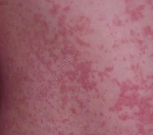 Rash 101: The Most Common Types of Skin Rashes