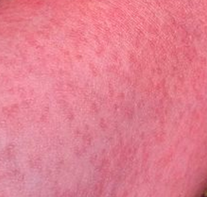 rash on legs and arms only - MedHelp
