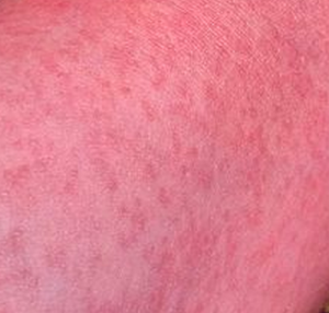 Photos Of Zika Rashes Will Make You Want To Slather On The ...