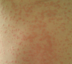symptoms of zika rash #10