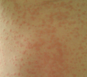 Slide show: Common skin rashes - Mayo Clinic