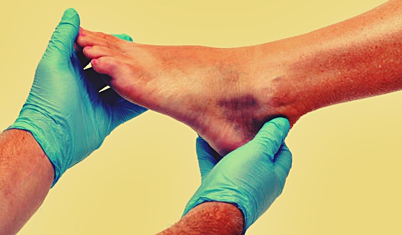 broken-foot-image