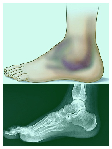 broken-foot-pic