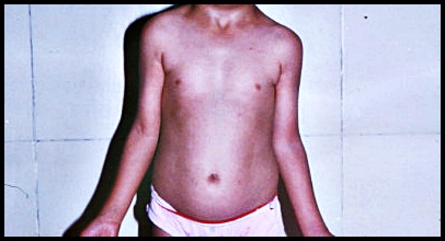 noonan-syndrome-images