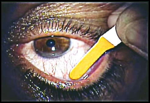 scratched-cornea-images