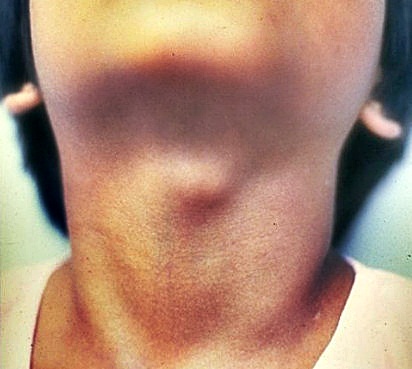 cyst-in-throat-images