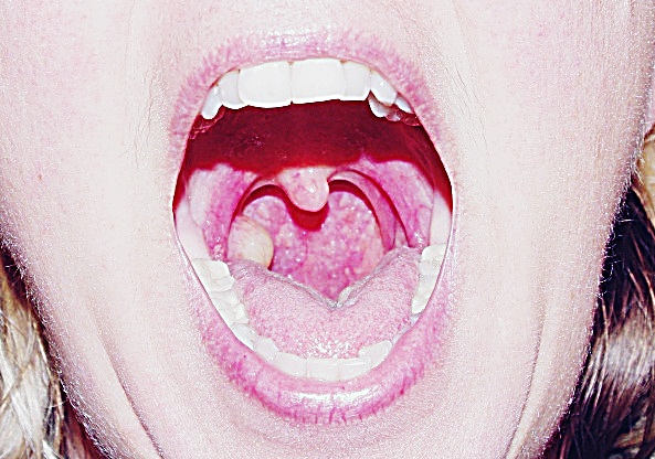 cyst-in-throat