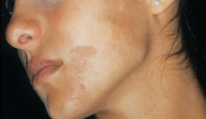 Brown Spots on Face – How to get rid of them
