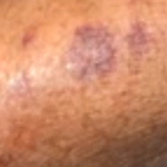 Purple Spots on Skin