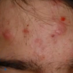 Spots on Forehead