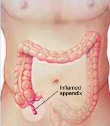 Appendix Pain – Location, Symptoms, Causes, Diagnosis,Treatment