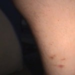 Flea Bites on Humans – Pictures, Symptoms, Treatment, Home Remedies
