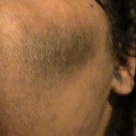 Acanthosis Nigricans – Pictures, Symptoms, Causes, Treatment