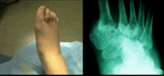 Charcot Foot – Pictures, Surgery, Symptoms, Causes, Treatment
