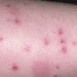 Bed Bug Bite – Pictures, Symptoms, Treatment