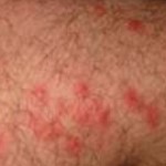 Poison Ivy Rash – Pictures, Symptoms, Causes, Treatment