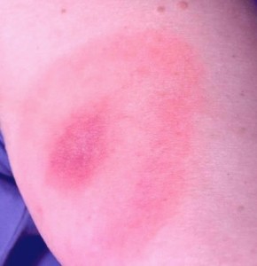 Pictures of Tick Bites, Symptoms, Causes, Treatment