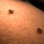 Tick Bites – Pictures, Symptoms, Causes, Treatment