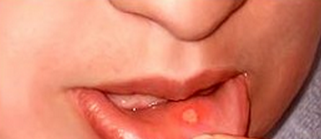 Cold sore in mouth
