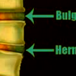 Bulging Disc vs Herniated Disc