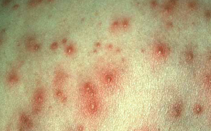 Folliculitis - Pictures, Symptoms, Causes, Treatment