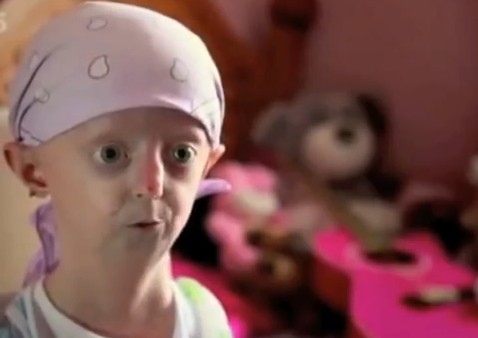 Progeria – Facts, Pictures, Symptoms, Causes, Treatment, Life Expectancy