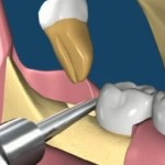 Wisdom Teeth Removal – Pain Relief
