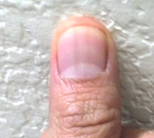 Black lines on fingernails