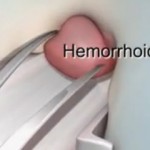 Hemorrhoidectomy – Procedure, Recovery, Pain Relief