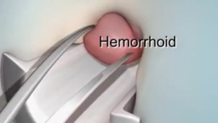 Hemorrhoidectomy – Procedure, Recovery, Pain Relief