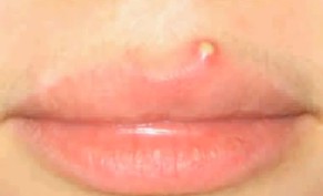 Pimple on Lip