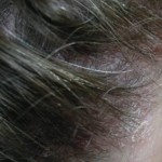 Pimples on scalp