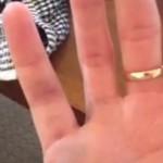 Swollen Pinky Finger