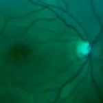Blind spots in vision