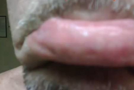 Fordyce Spots on Lips
