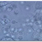 Leukocytes in Urine without Nitrates