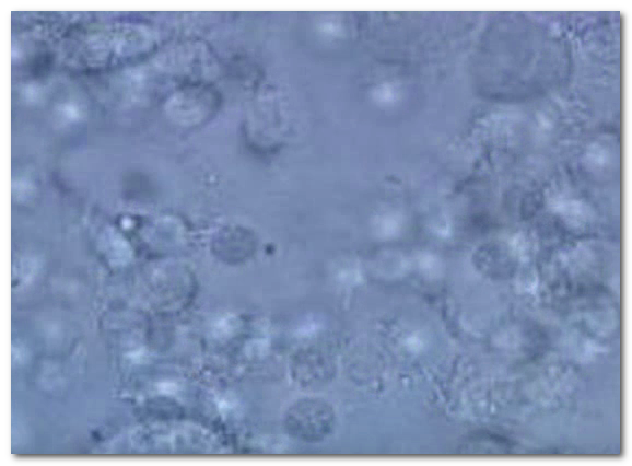 Leukocytes in Urine without Nitrates