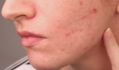 Red Spots on Skin (Non Itchy)