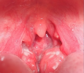 Swollen Tonsils with White Spots