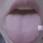 Scalloped Tongue