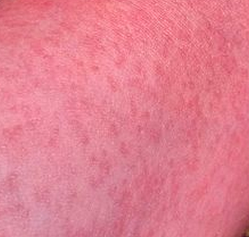 Zika Rash - Pictures, Treatment, Symptoms, Causes, Prevention