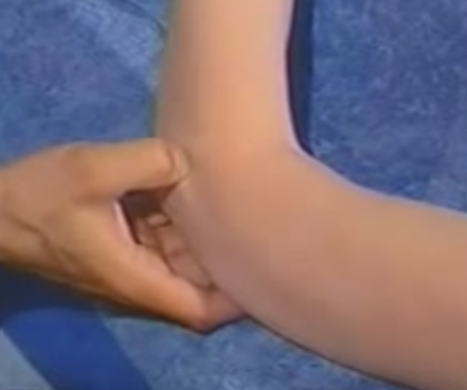 Elbow Contusion