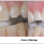 Zoom Whitening – All You Wanted to Know