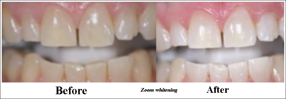 Zoom Whitening – All You Wanted to Know