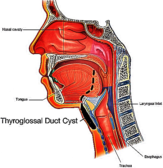 Cyst in Throat
